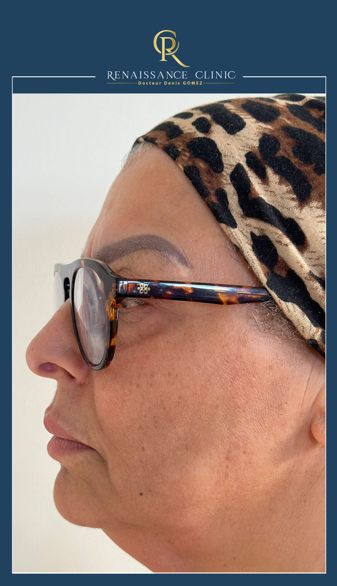 Lipolyse loge graisseuse région sous mentonnière + remise en tension cutané ovale du visage