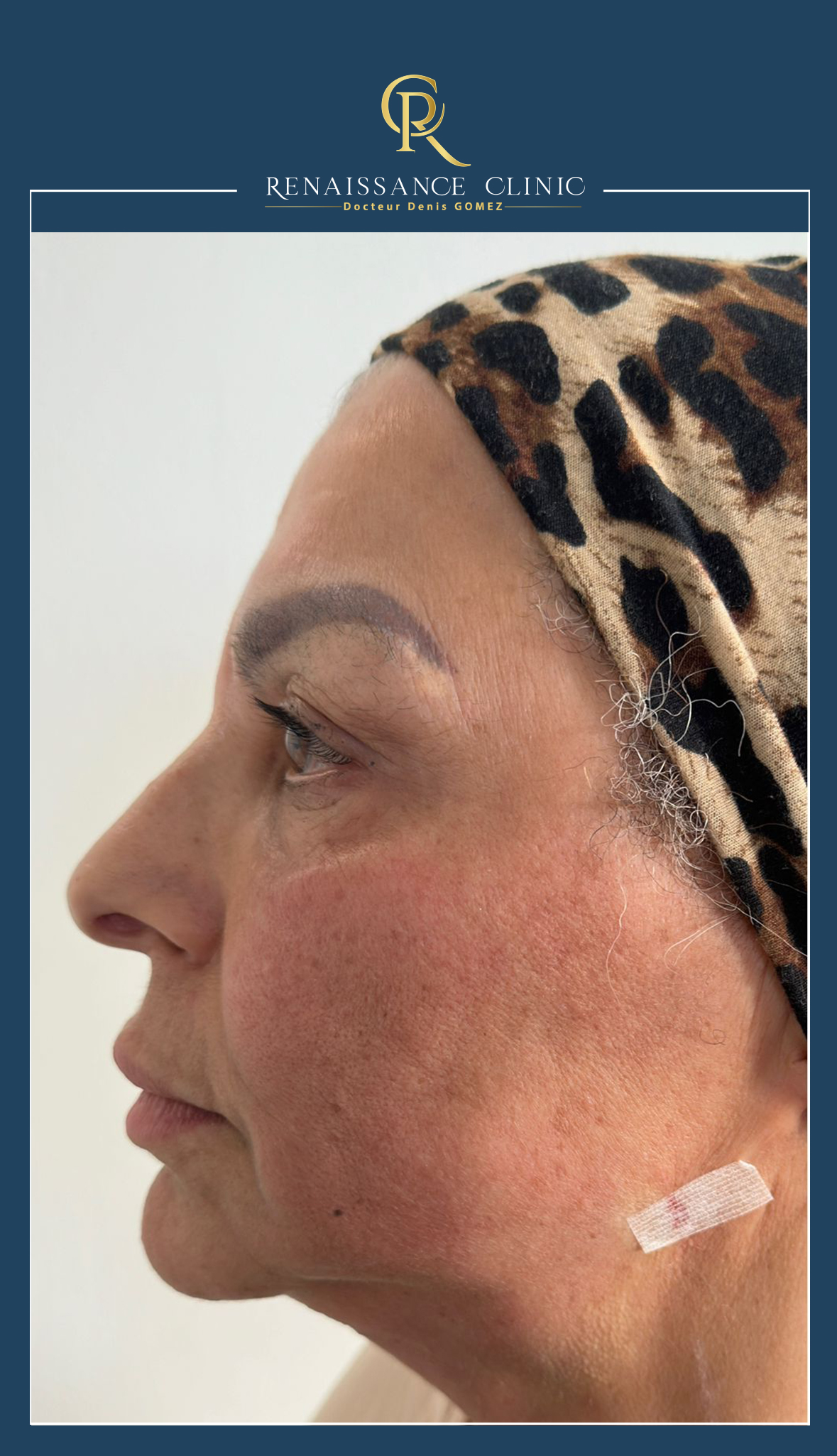 Lipolyse loge graisseuse région sous mentonnière + remise en tension cutané ovale du visage