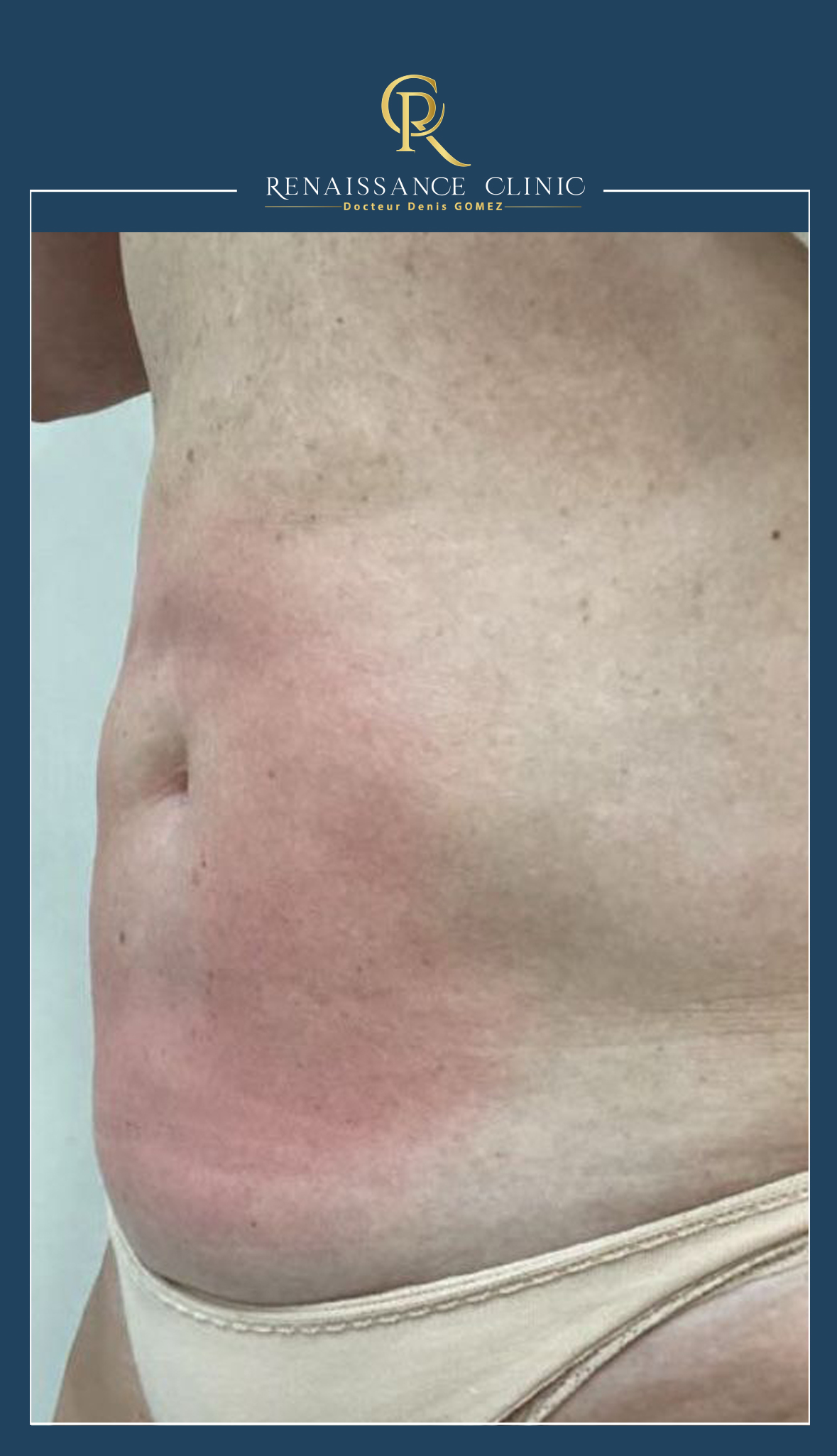CRYOLIPOLYSE ventre entier + 4séances MORPHEUS