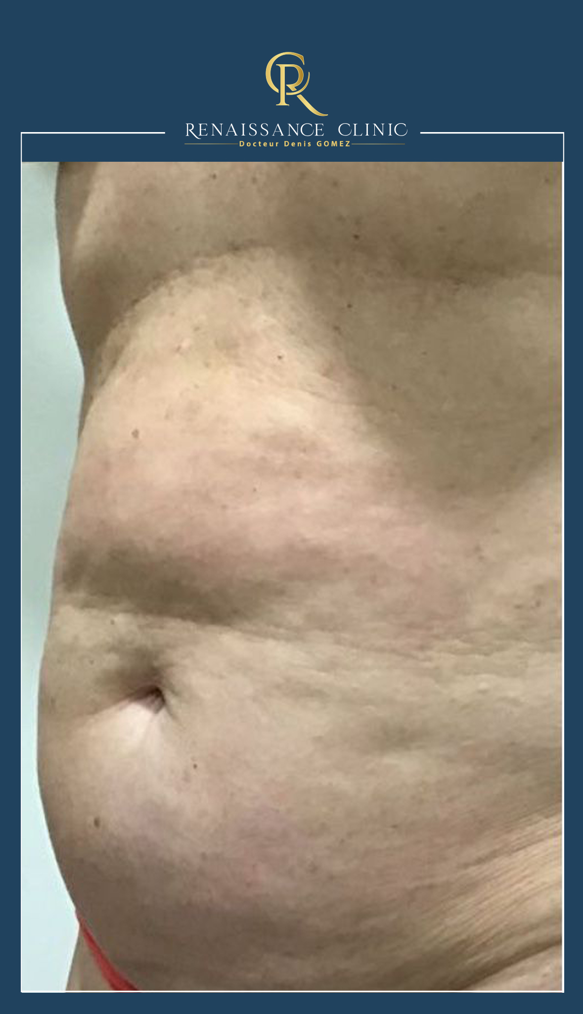 CRYOLIPOLYSE ventre entier + 4séances MORPHEUS
