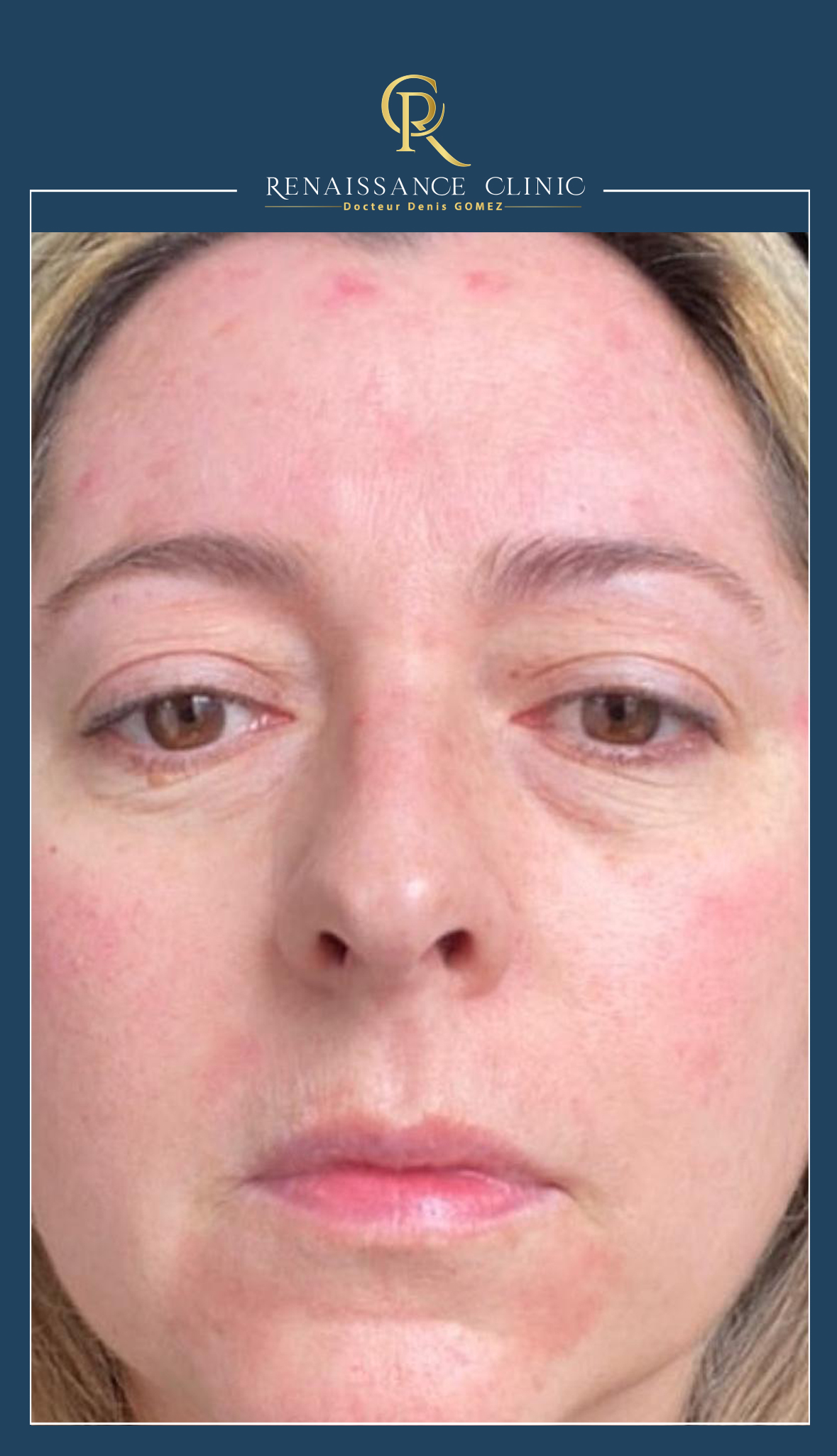 Peeling moyen TCA full face