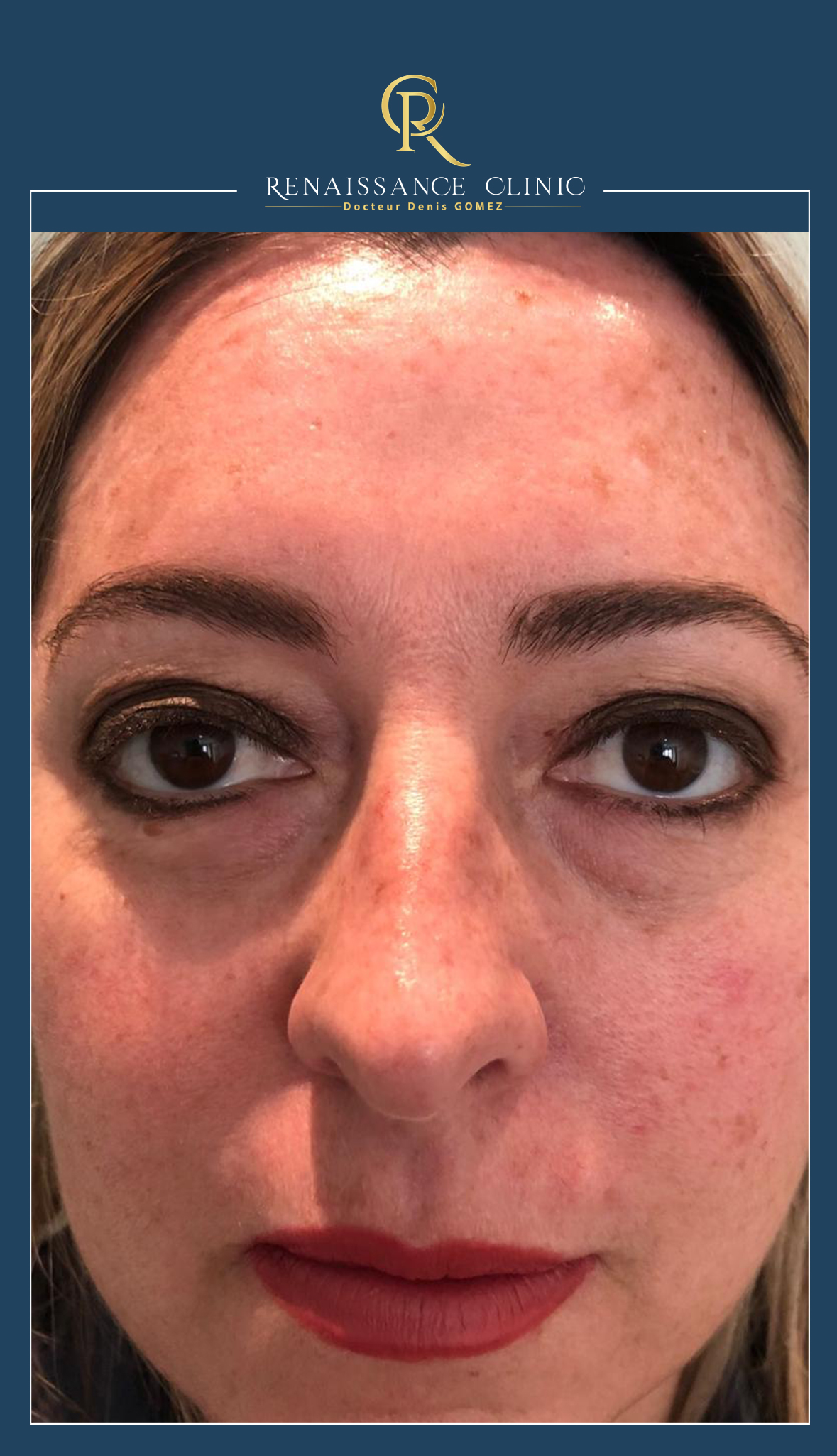 Peeling moyen TCA full face