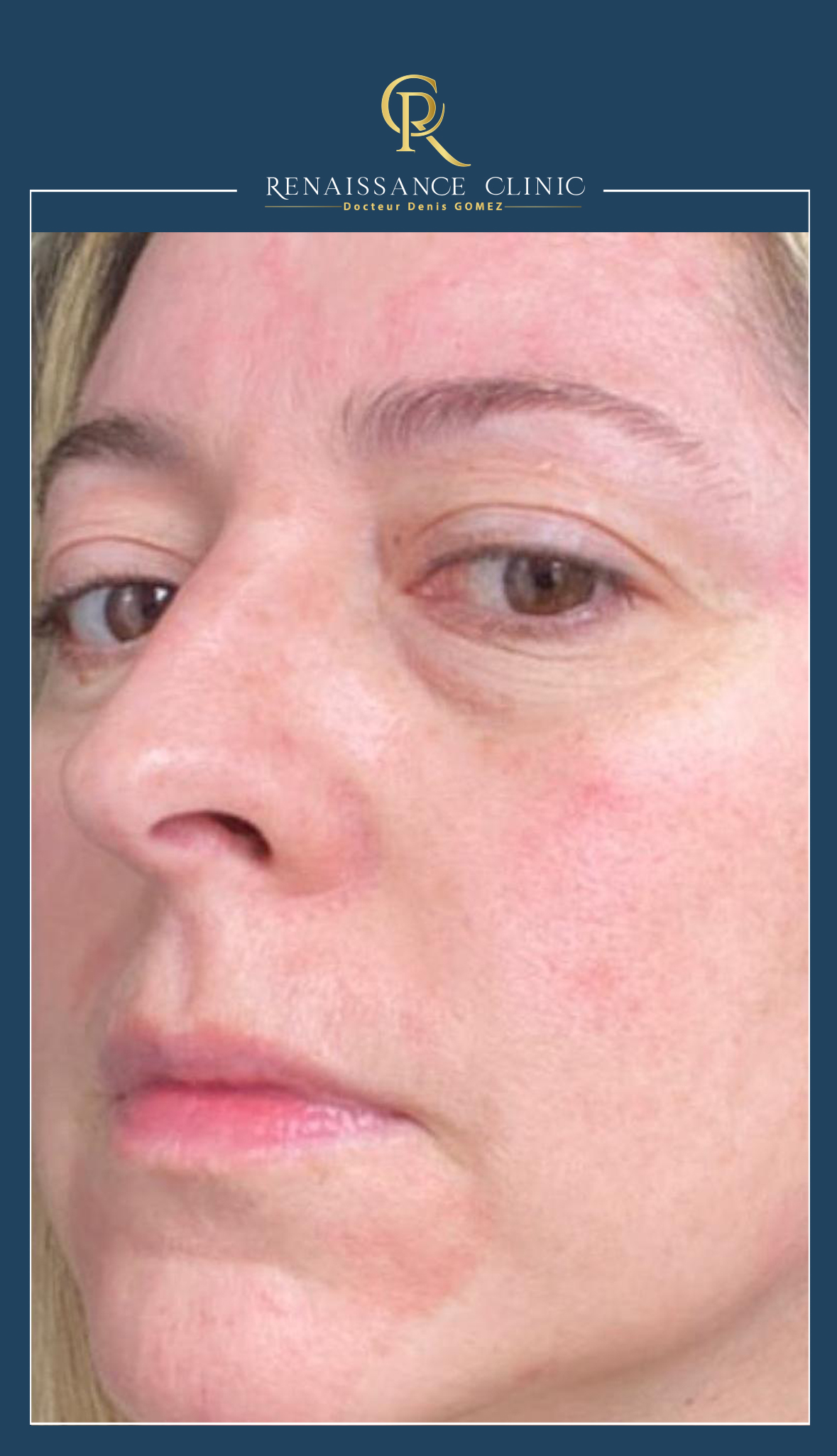 Peeling moyen TCA full face