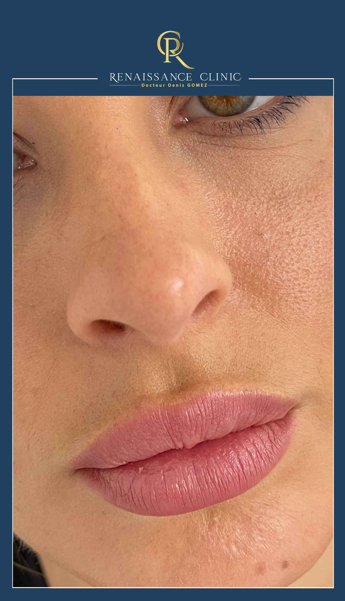 Injection des lèvres par acide hyaluronique technique Russian lips