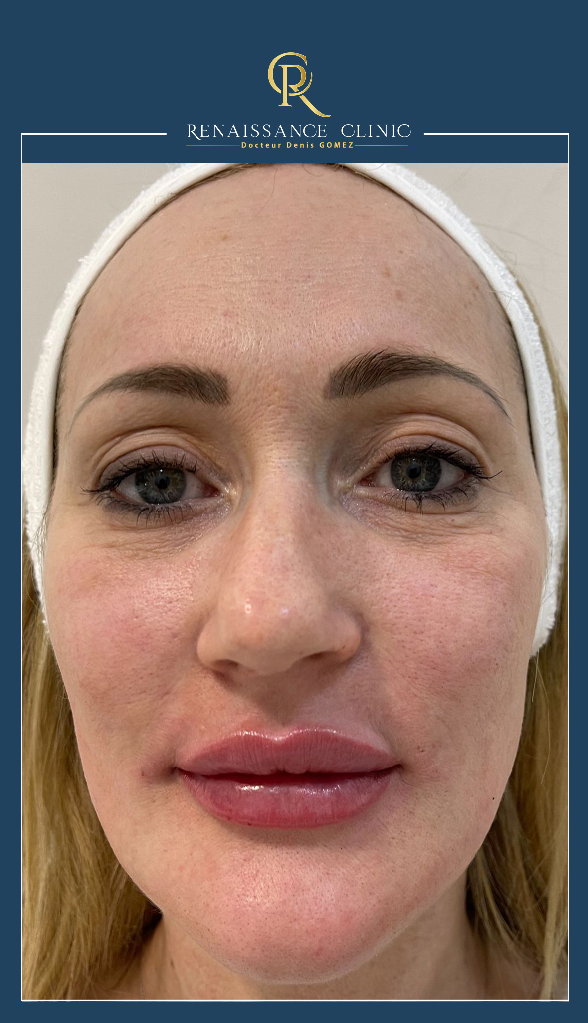 Injection des lèvres par acide hyaluronique technique Russian lips