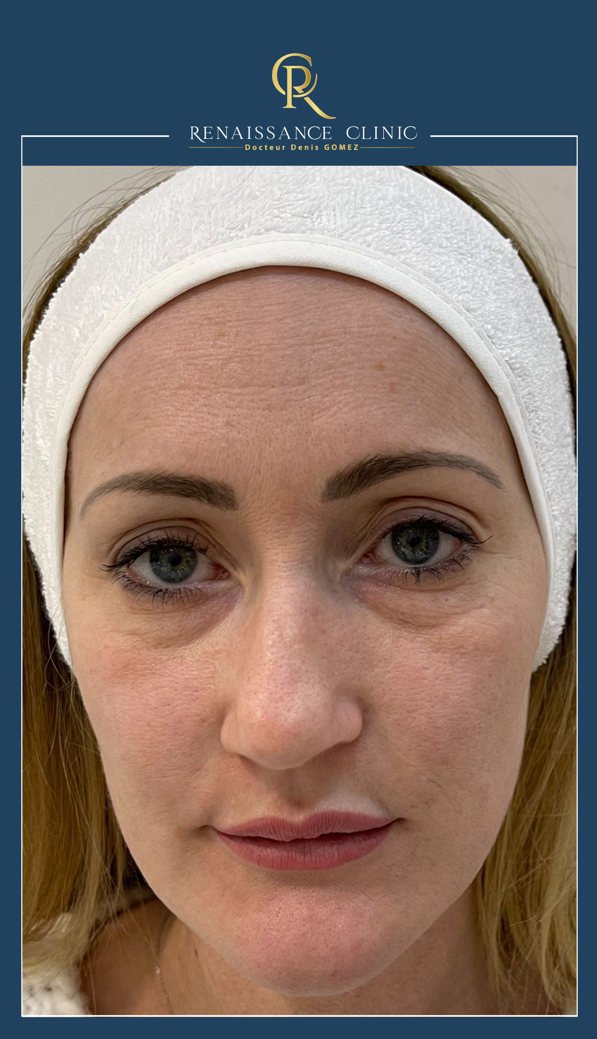 Injection des lèvres par acide hyaluronique technique Russian lips