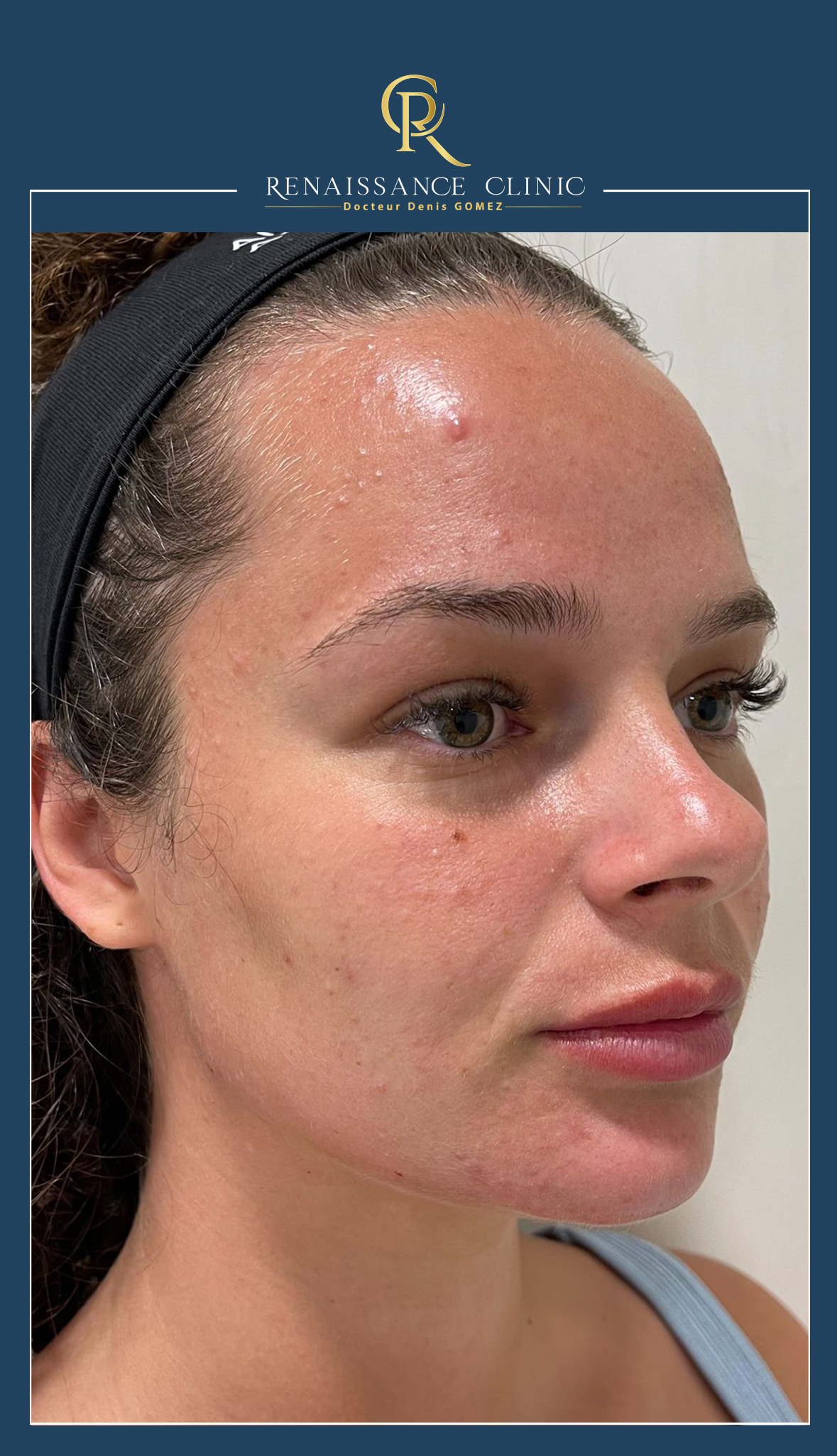 Injection Acide Hyaluronique Jawline