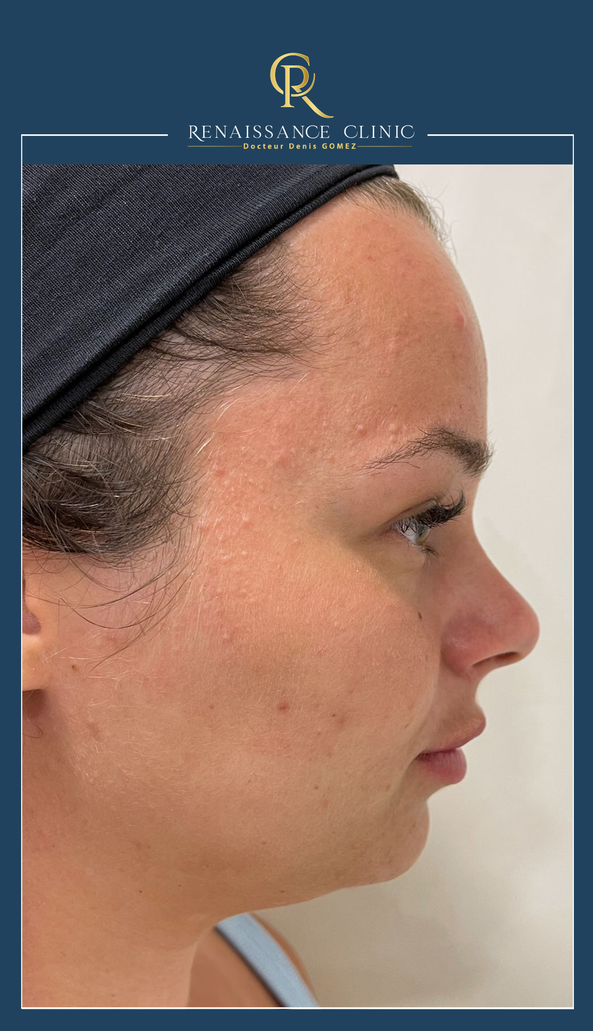 Injection Acide Hyaluronique Jawline