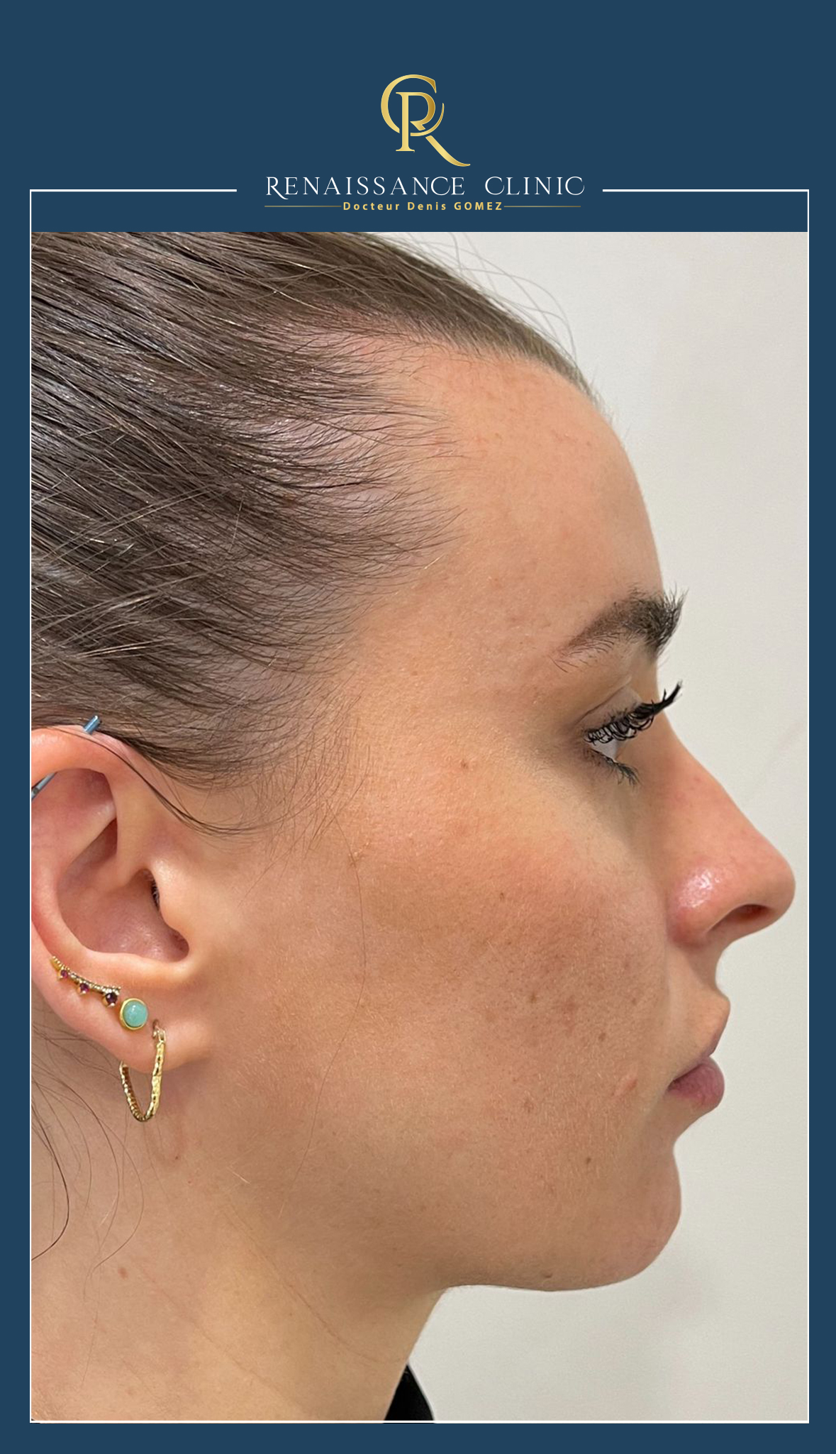 Injection Acide Hyaluronique Jawline