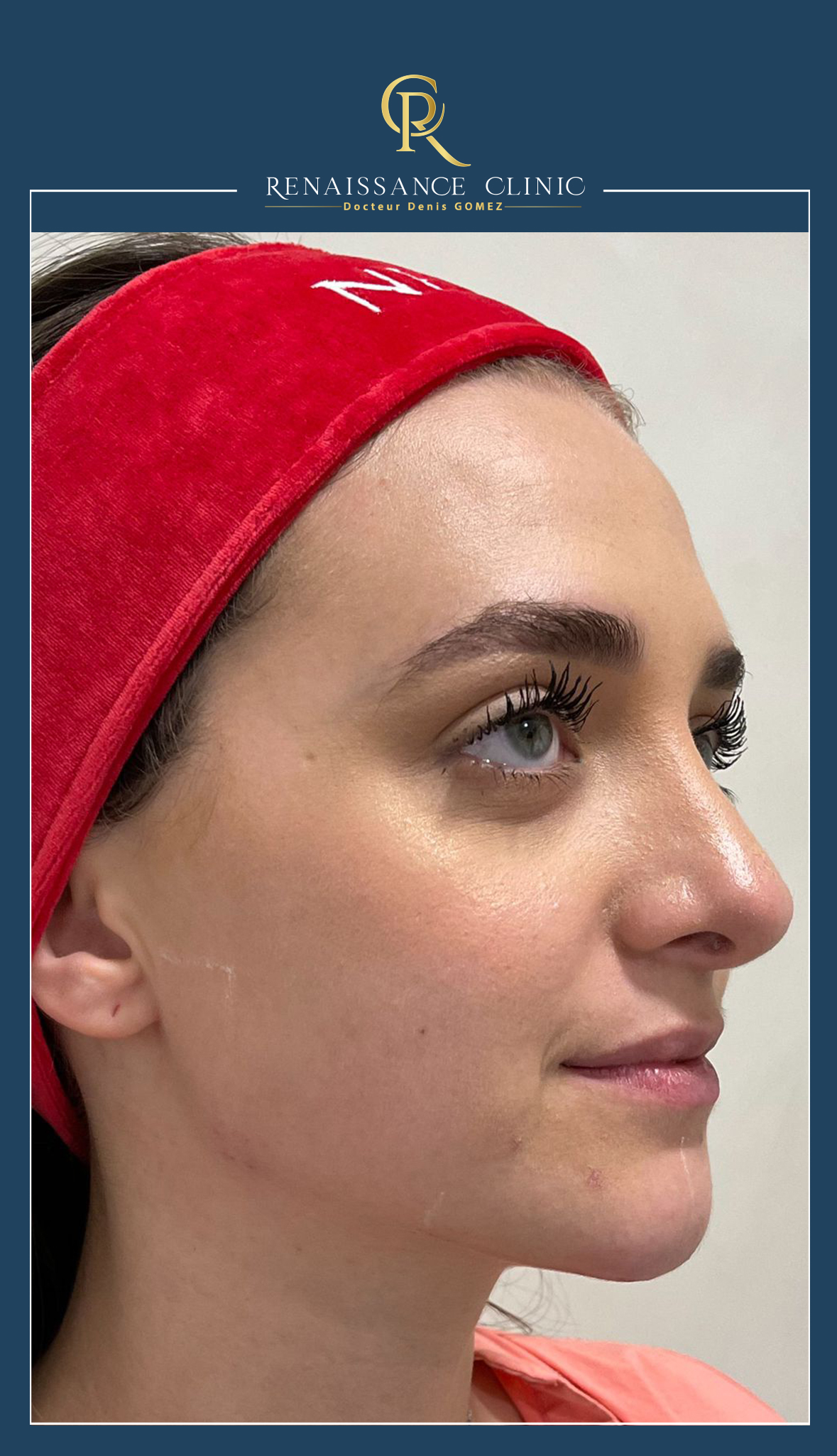 Injection Acide Hyaluronique Jawline