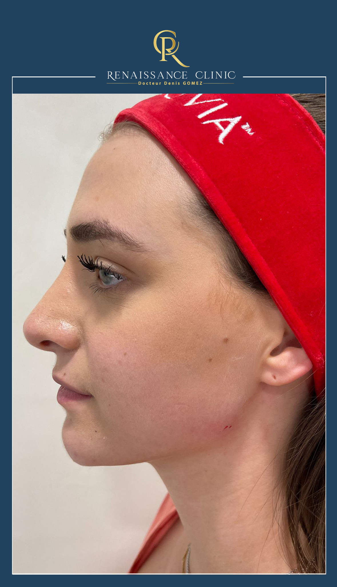 Injection Acide Hyaluronique Jawline