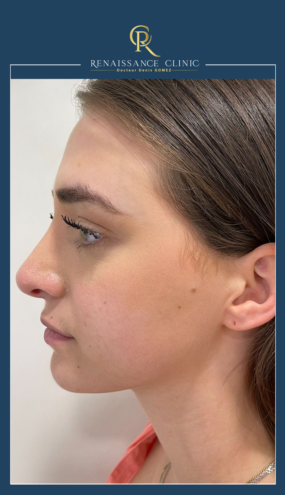 Injection Acide Hyaluronique Jawline