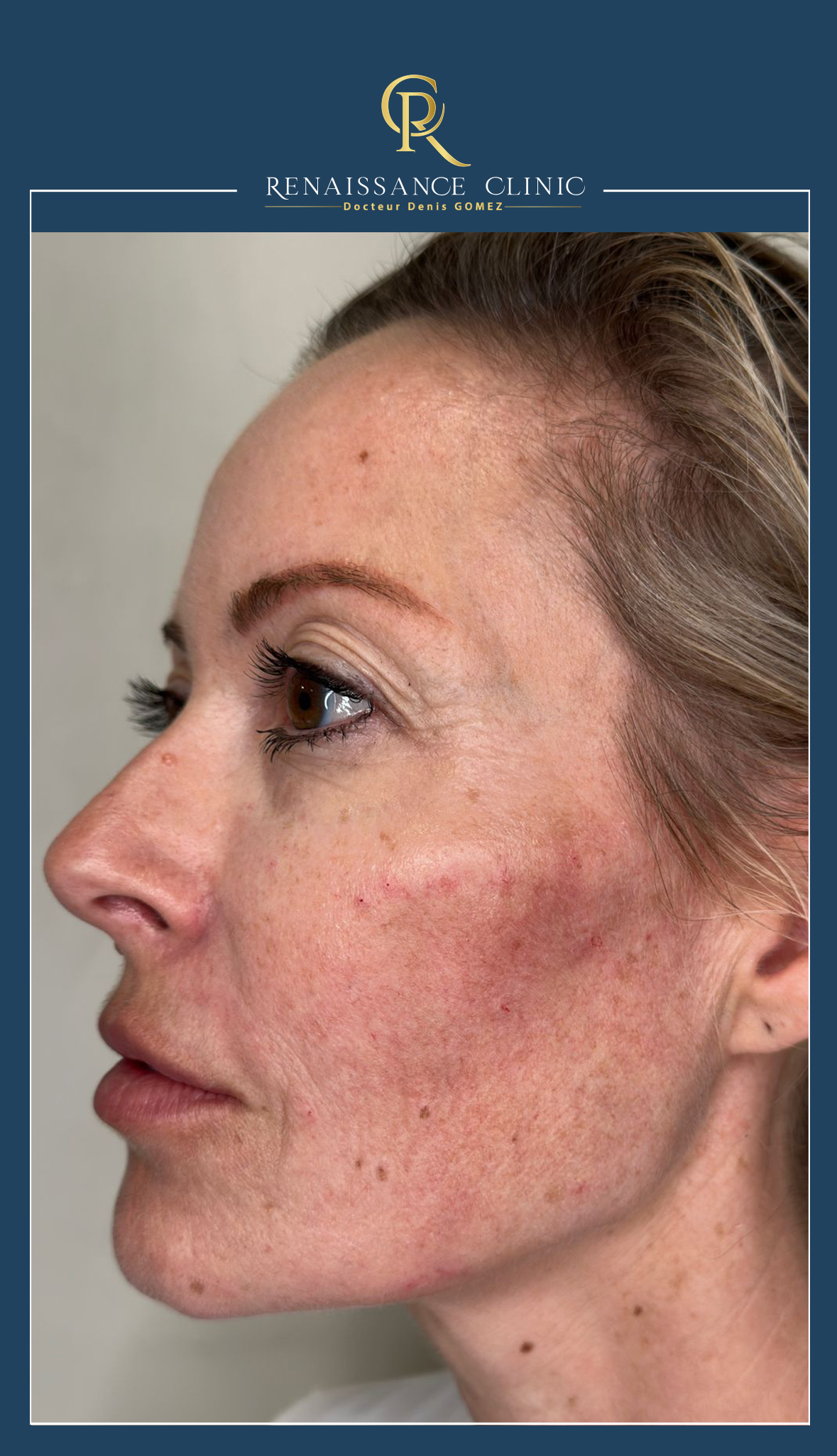 Inducteurs collagéniques HARMONYCA Jawline + injections acide hyaluronique full face