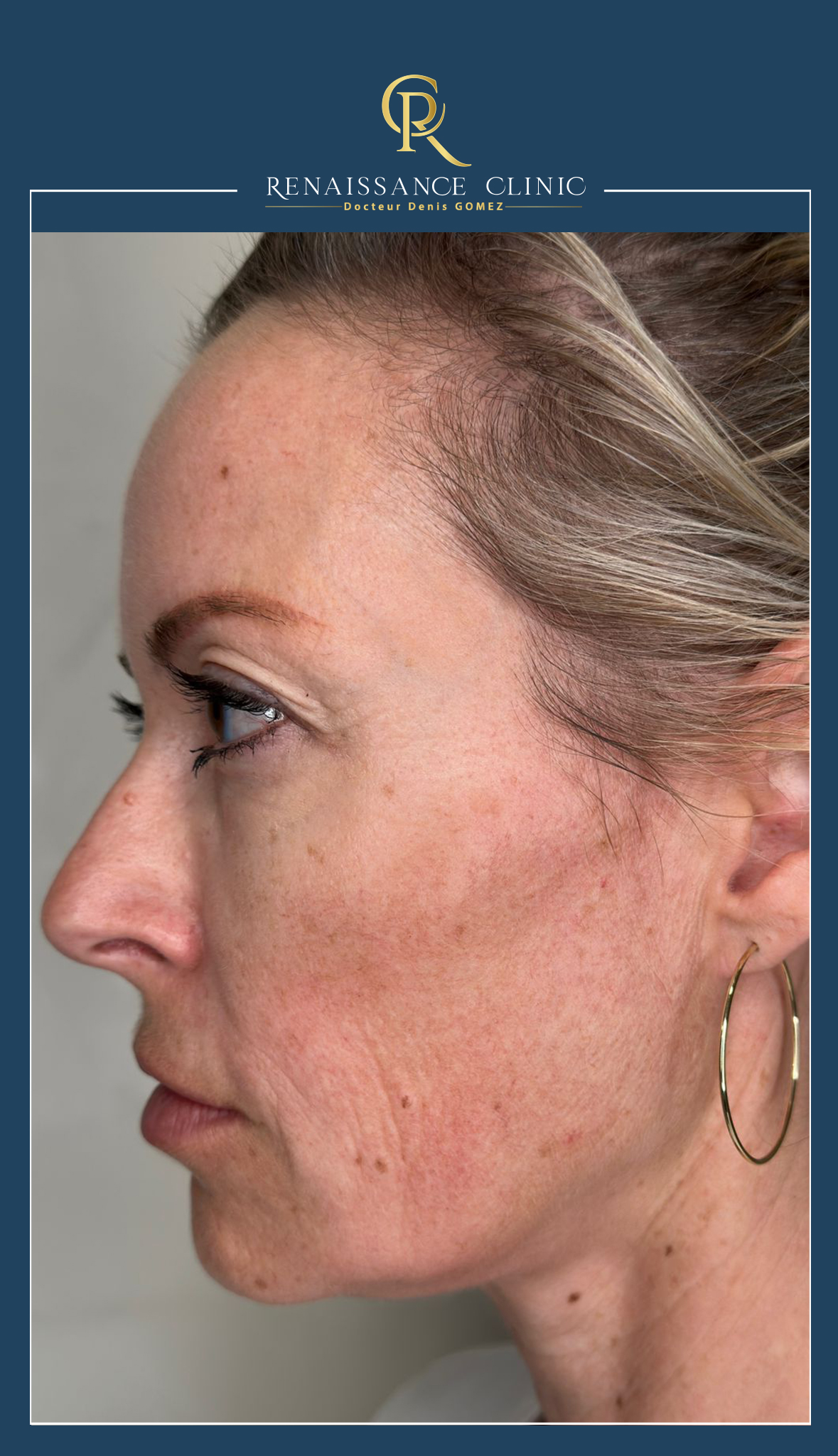 Inducteurs collagéniques HARMONYCA Jawline + injections acide hyaluronique full face
