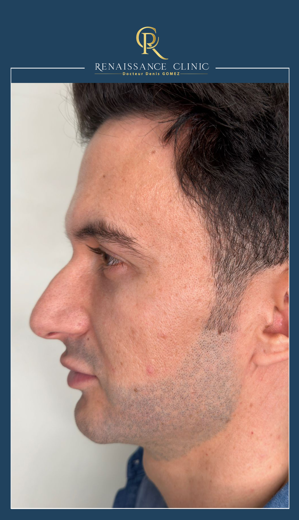 Injection-ACIDE-HYALURONIQUE-JAWLINE