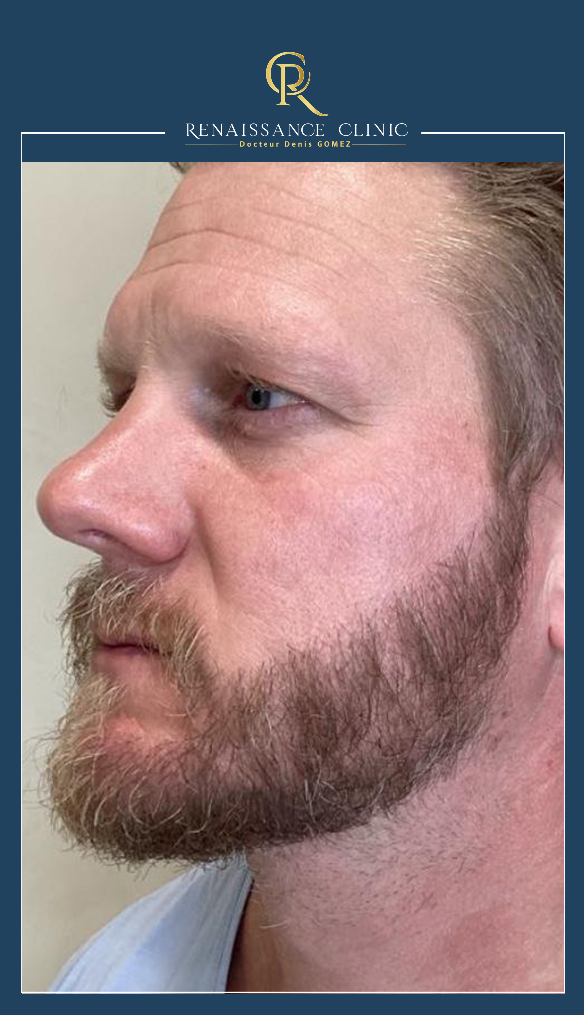 Micro Greffe Barbe 3.000 greffons - Résultants à 12 mois post-opératoire