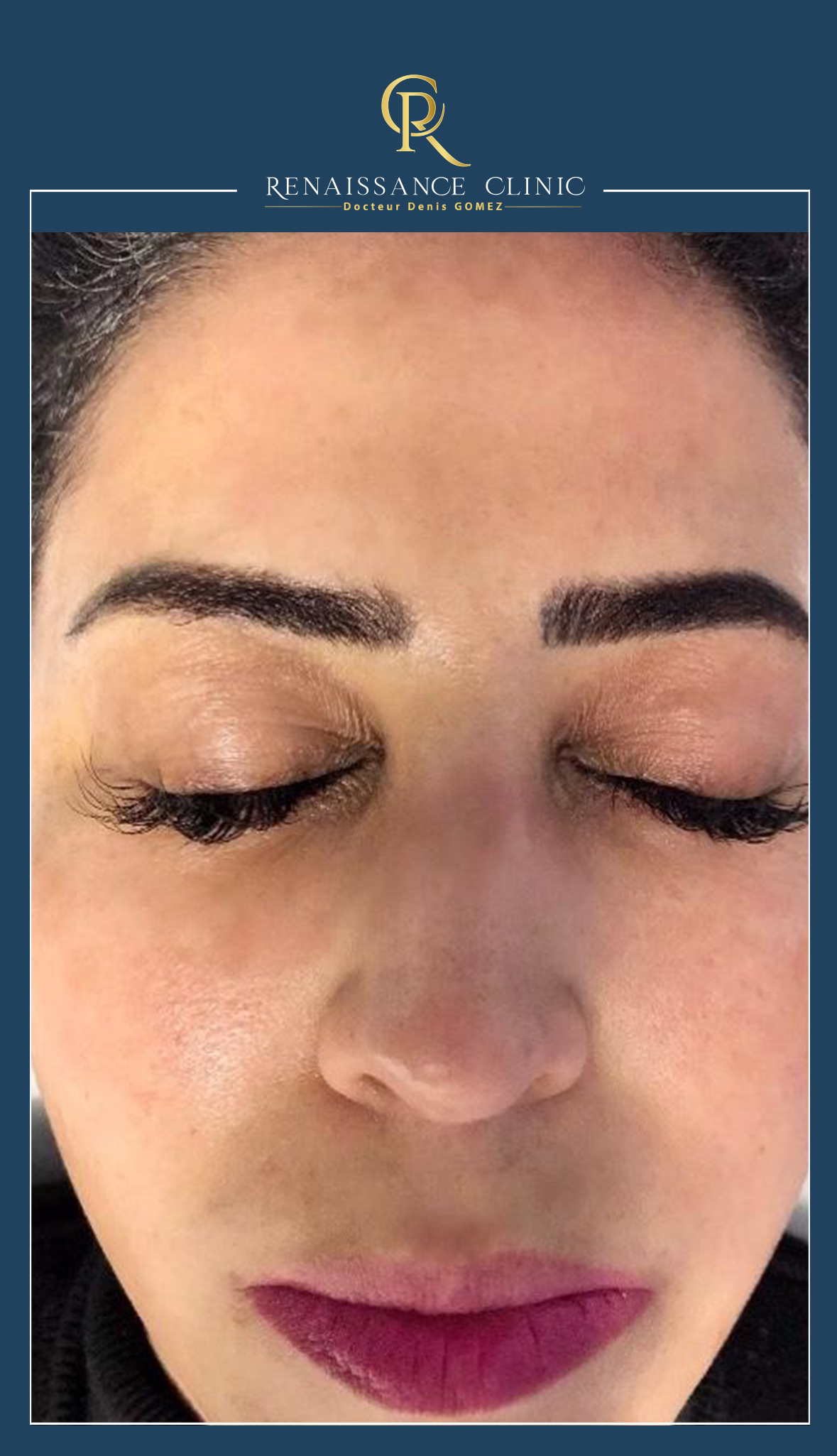 Peeling dépigmentation MELAPEEL FORTE traitement du mélasma