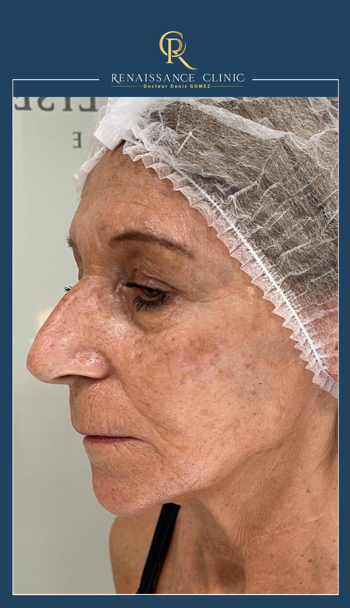 fils tenseurs ovale du visage