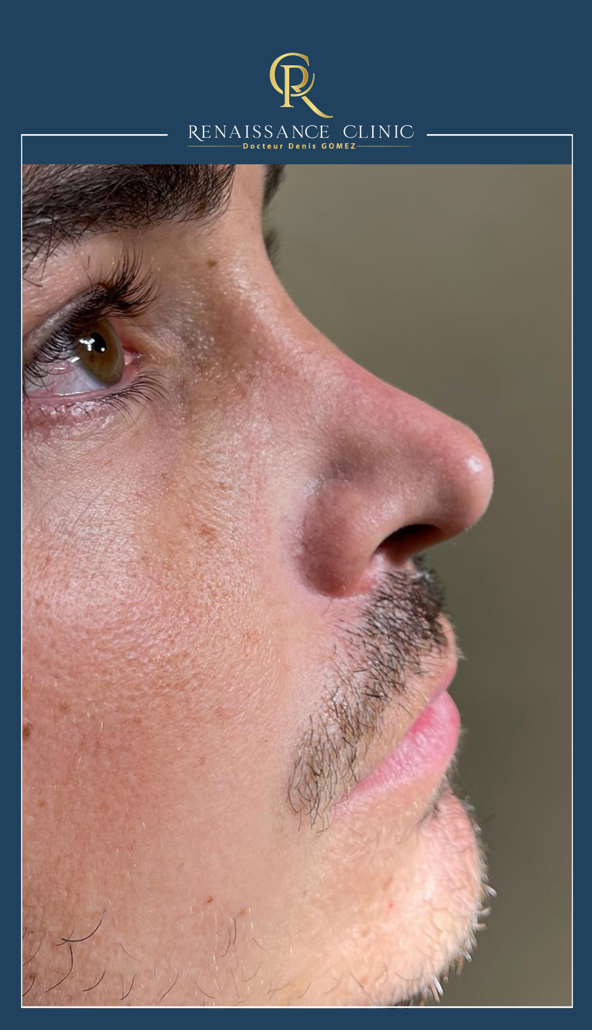 Rhinoplastie médicale par-injection acide Hualuronique