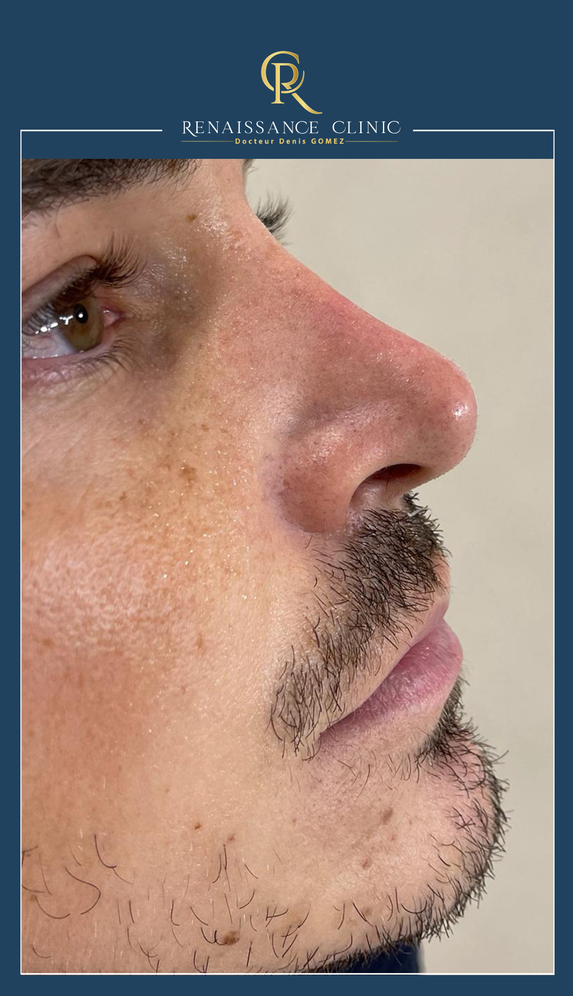 Rhinoplastie médicale par-injection acide Hualuronique