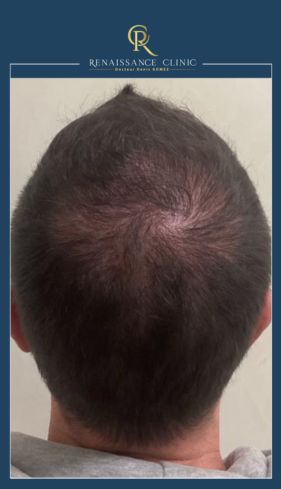 Protocole HAIR-FILLER Dr-Cyj + mésothérapie capillaire dans le traitement de l’alopécie androgenogenetique