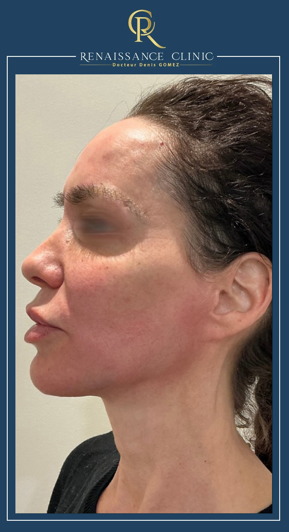 avant après endolift