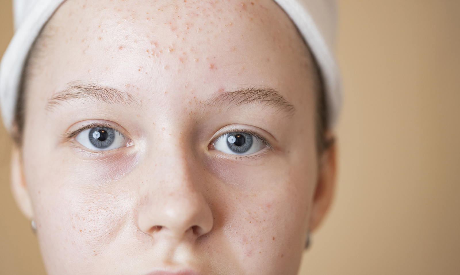 Traitement cicatrices d’acné à Nice