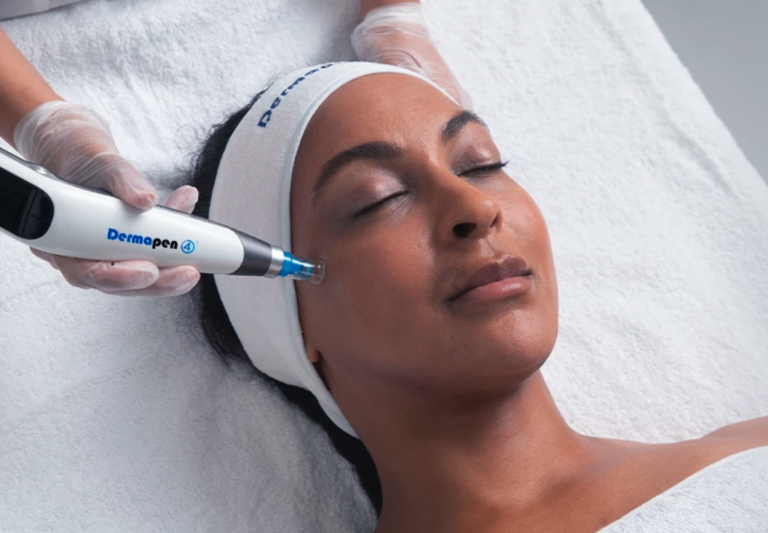 Microneedling Nice : pores, taches, cicatrices, rides