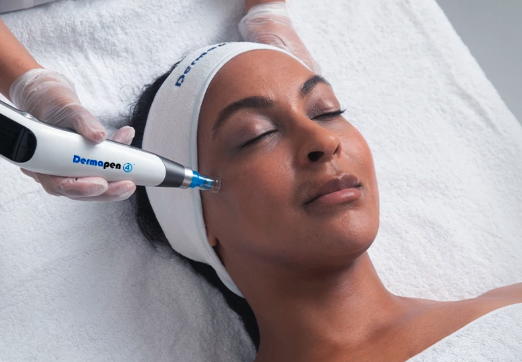 Microneedling Nice : pores, taches, cicatrices, rides