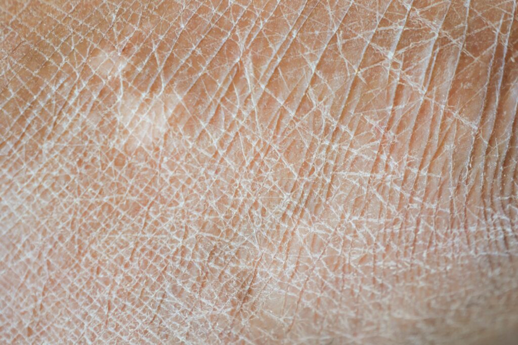 Traitement de la peau sèche à Nice : gros plan sur une peau déshydratée et sa texture cutanée