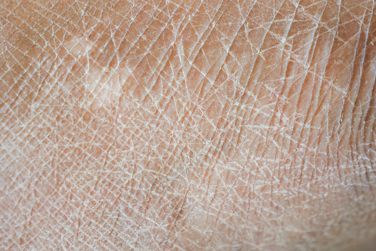 Traitement de la peau sèche à Nice : gros plan sur une peau déshydratée et sa texture cutanée