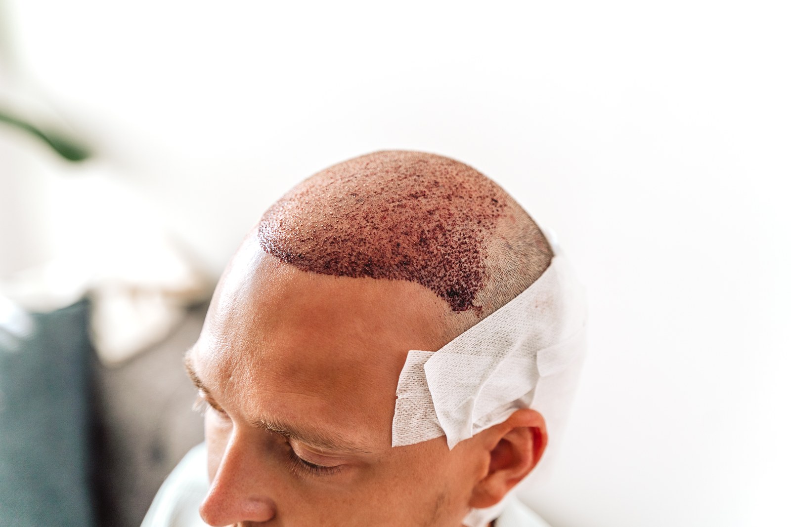 Cuir chevelu d’un patient après une greffe de cheveux à Nice